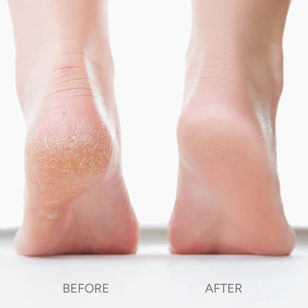 SmoothSole Pro